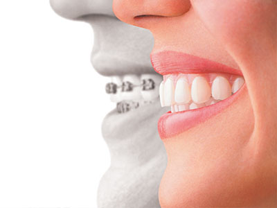 The image is a composite graphic showing a person s face with a smile on one side and a dental implant on the other.