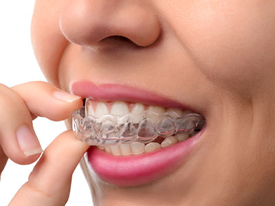 An individual wearing a clear aligner, a dental appliance used for orthodontic treatment, with their hand holding the aligner in front of their mouth.