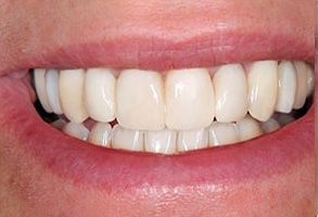 The image shows a close-up of a person s smiling mouth, revealing white teeth and gums.