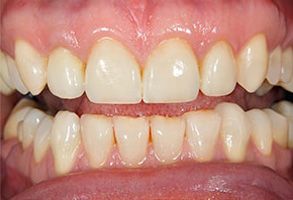 The image shows a close-up of a person s mouth with teeth, including some that are yellowed or discolored.